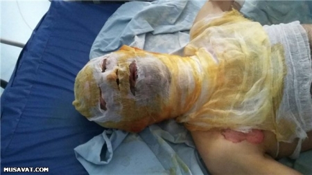 Kredit borcuna görə özünü yandıran şəxsin vəziyyəti ağırdır - FOTO