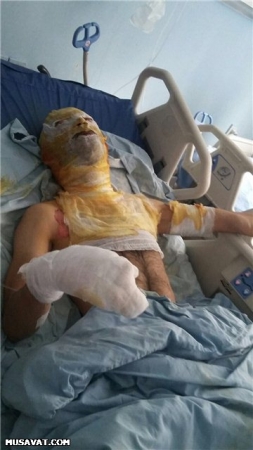 Kredit borcuna görə özünü yandıran şəxsin vəziyyəti ağırdır - FOTO