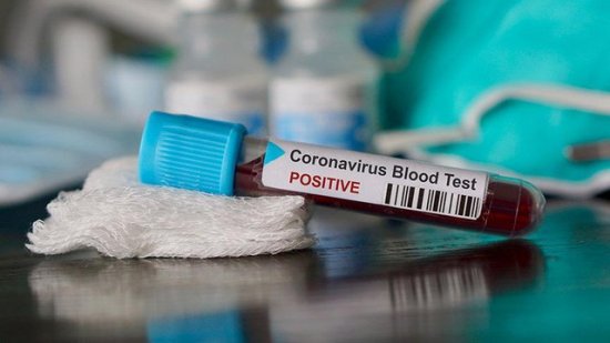 Azərbaycanda daha 131 nəfər koronavirusa yoluxub, 143 nəfər sağalıb, 1 nəfər ölüb